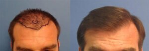 Strip Hair Transplant