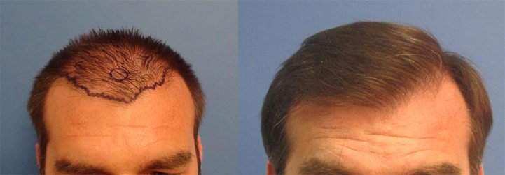 Strip Hair Transplant