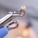 Tooth Extraction Holly Springs NC for Safe and Comfortable Dental Care