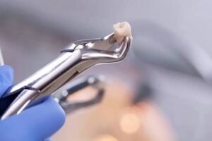 Tooth Extraction Holly Springs NC for Safe and Comfortable Dental Care