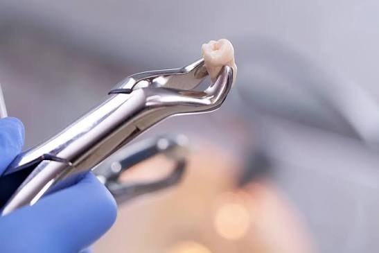 Tooth Extraction Holly Springs NC for Safe and Comfortable Dental Care