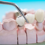 dental bridges glendale az