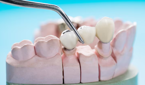 dental bridges glendale az