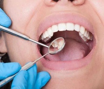 Root Canal Treatment