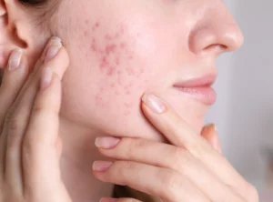 Acne-Scars