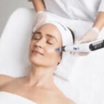 microneedling Edmonton