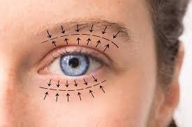 Blepharoplasty in Dubai