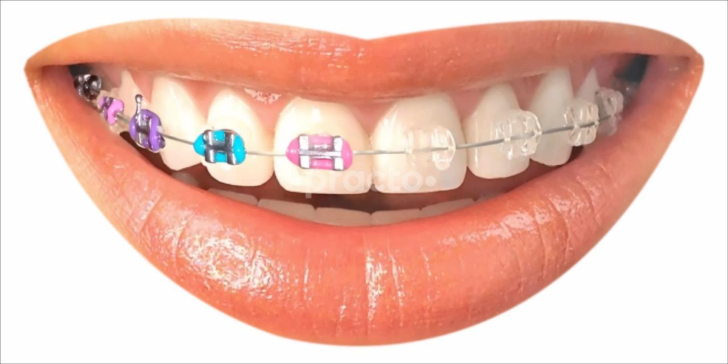From Crooked to Confident: A Friendly Guide to Braces Treatment Sonipat Families Are Choosing Today
