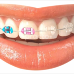 From Crooked to Confident: A Friendly Guide to Braces Treatment Sonipat Families Are Choosing Today