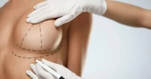 Breast Lift Surgery in Islamabad
