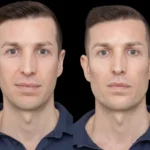 H2-Cheek-Fillers 2233