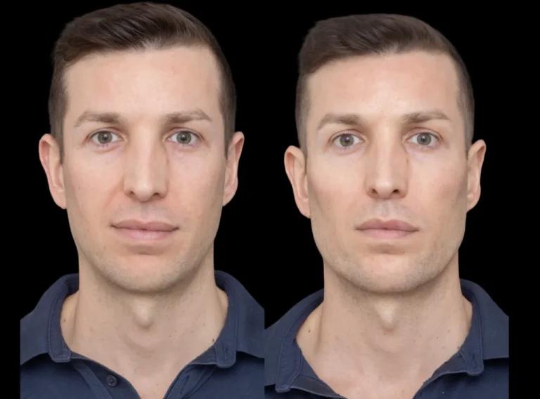 H2-Cheek-Fillers 2233