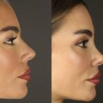 rhinoplasty islamabad