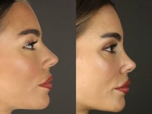 rhinoplasty islamabad