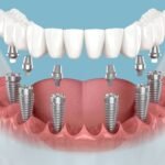 Dental Implant Near Me | Restore Your Smile with Dental Implants