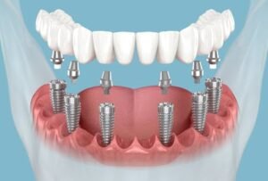Dental Implant Near Me | Restore Your Smile with Dental Implants