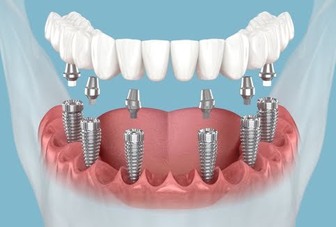 Dental Implant Near Me | Restore Your Smile with Dental Implants