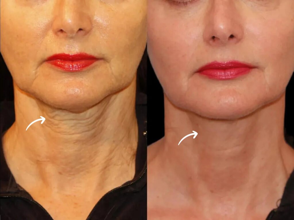sculptra fillers in dubai