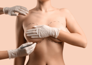 Mia Breast Implant In Dubai