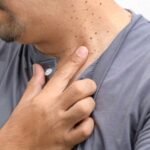 Seborrheic Keratosis Remedies and safe treatment options for common skin growths
