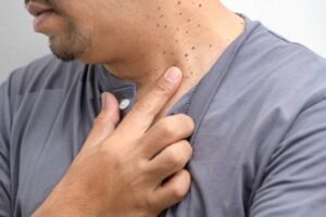 Seborrheic Keratosis Remedies and safe treatment options for common skin growths