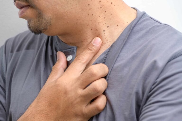 Seborrheic Keratosis Remedies and safe treatment options for common skin growths