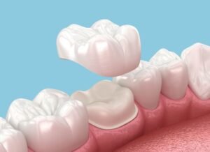 understanding-dental-crowns-and-bridges-what-they-are-and-how-they-work